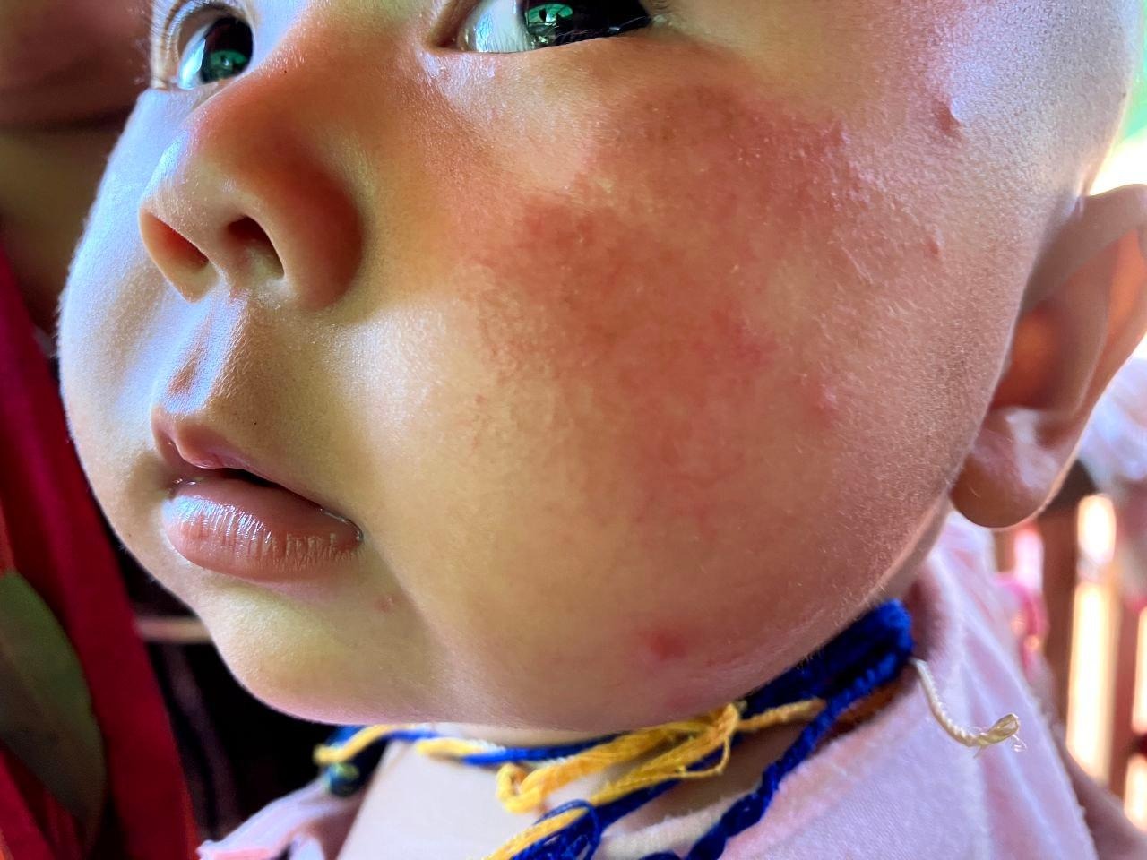 Skin Rash Outbreak Among Infants at IDP Camps in Deemawso Township